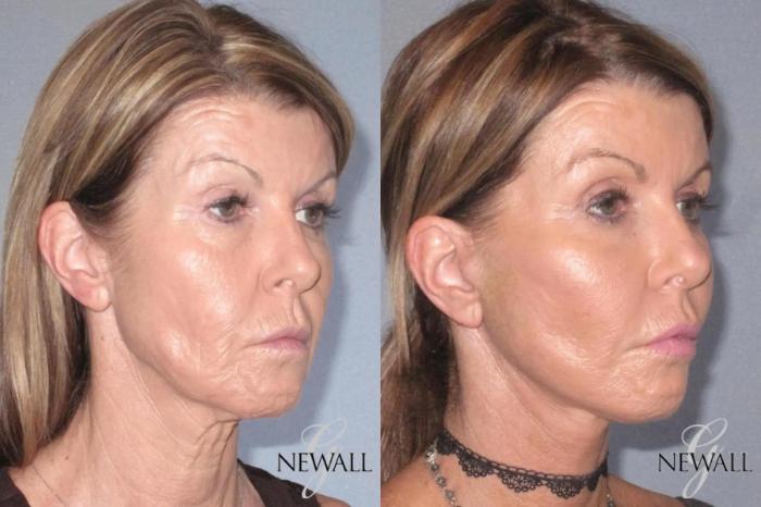 Before & After Facial Fat Grafting Case 17567 View 2 View in Houston, TX