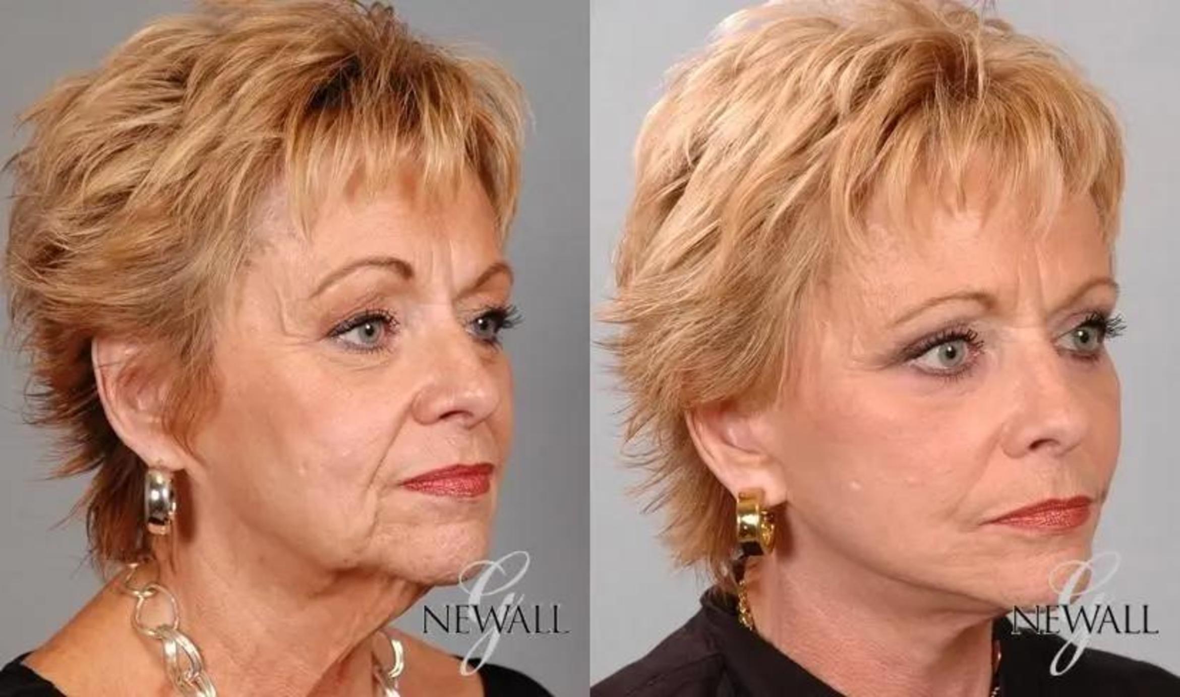 Before & After Facial Fat Grafting Case 17570 View 2 View in Houston, TX