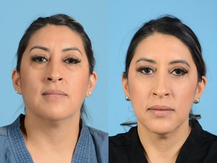 Before & After Facial Fat Grafting Case 18166 Front 1 View in Houston, TX