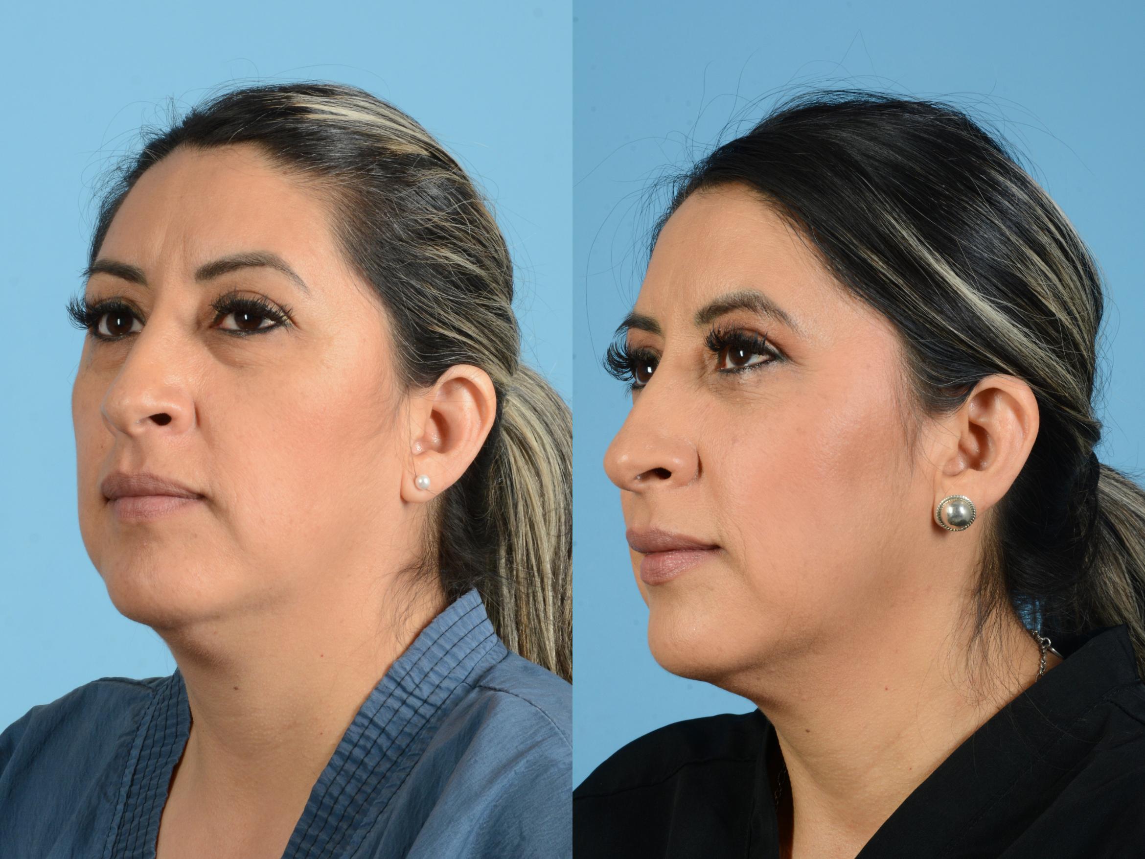 Before & After Facial Fat Grafting Case 18166 Left Oblique (Front) View in Houston, TX