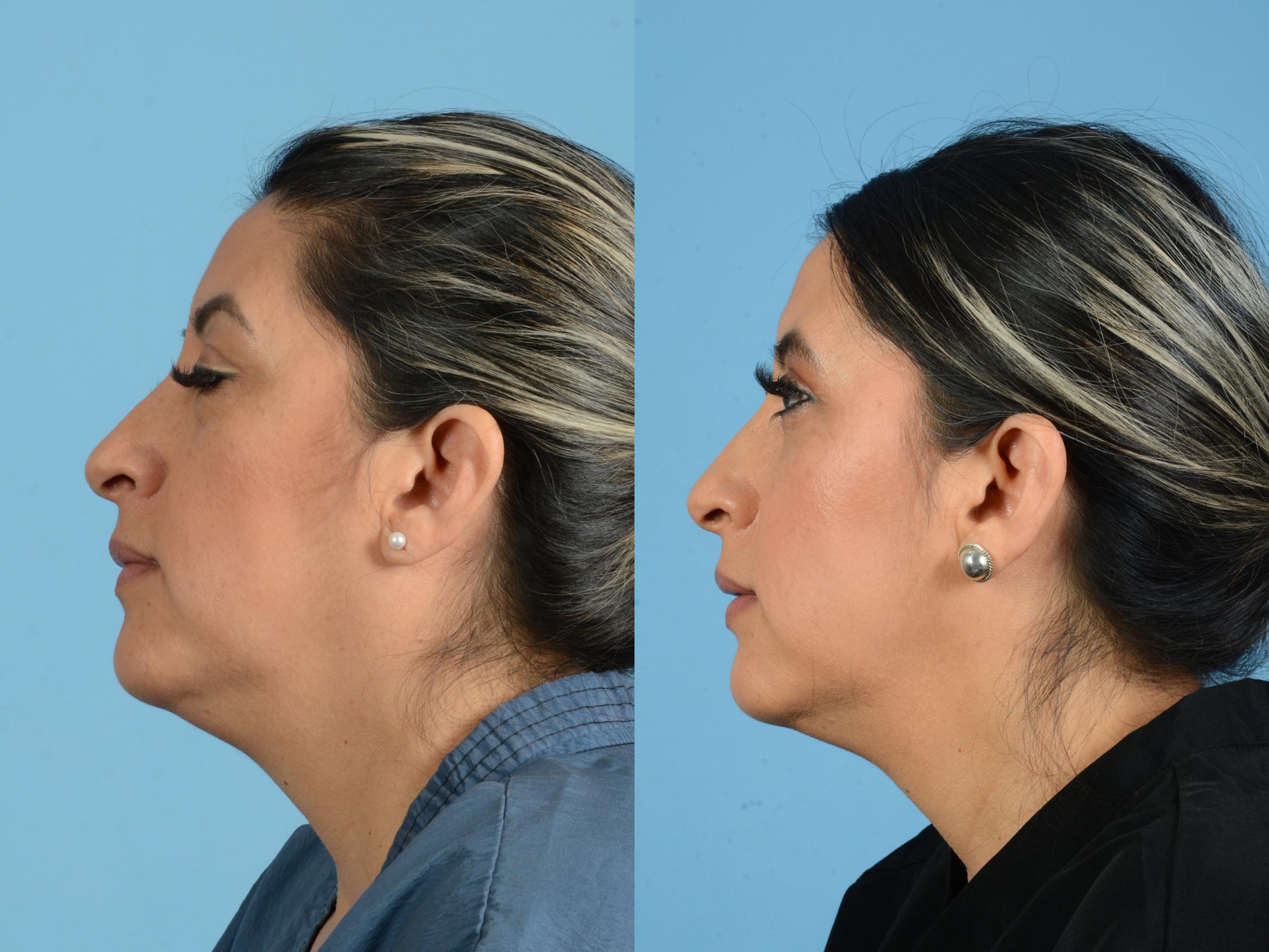 Before & After Facial Fat Grafting Case 18166 Left Side View in Houston, TX