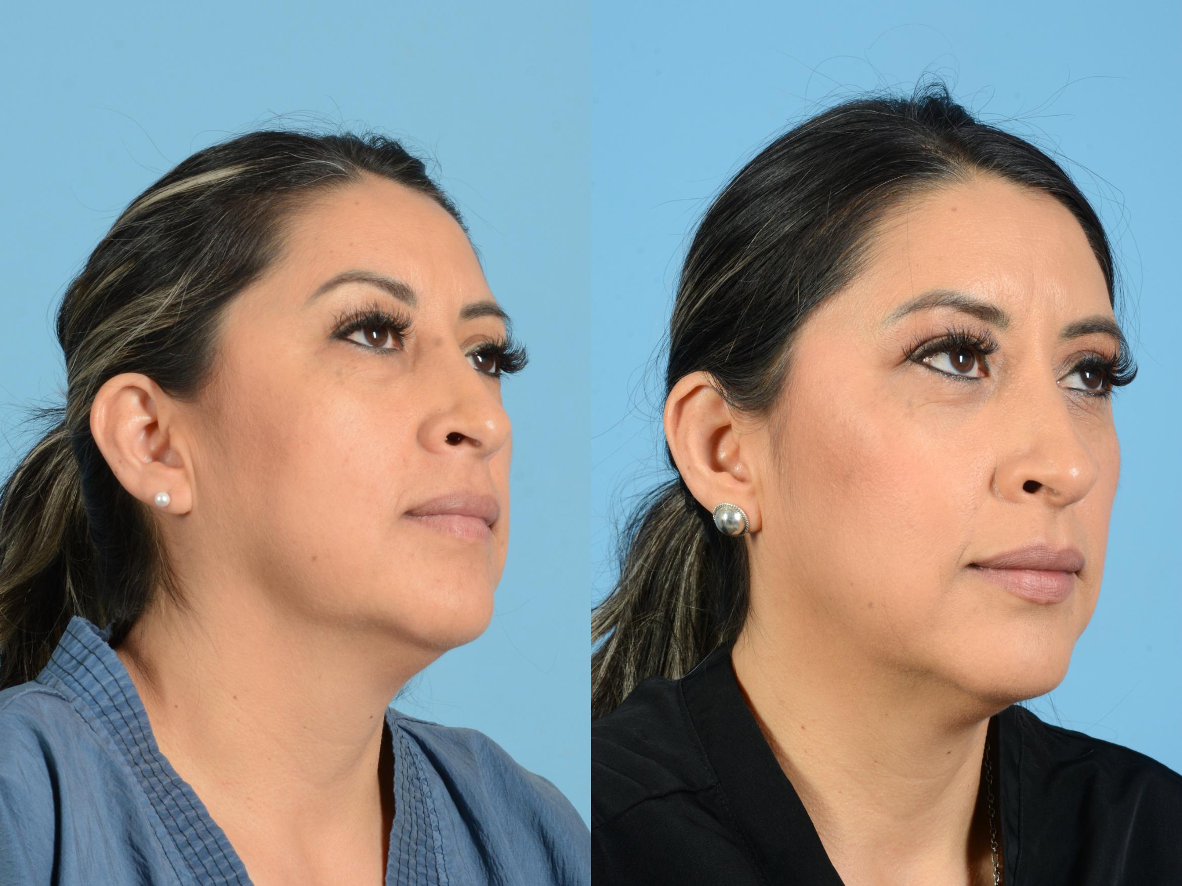 Before & After Facial Fat Grafting Case 18166 Right Oblique (Front) View in Houston, TX