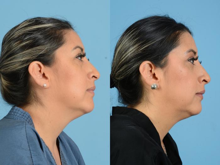 Before & After Facial Fat Grafting Case 18166 Right Side View in Houston, TX