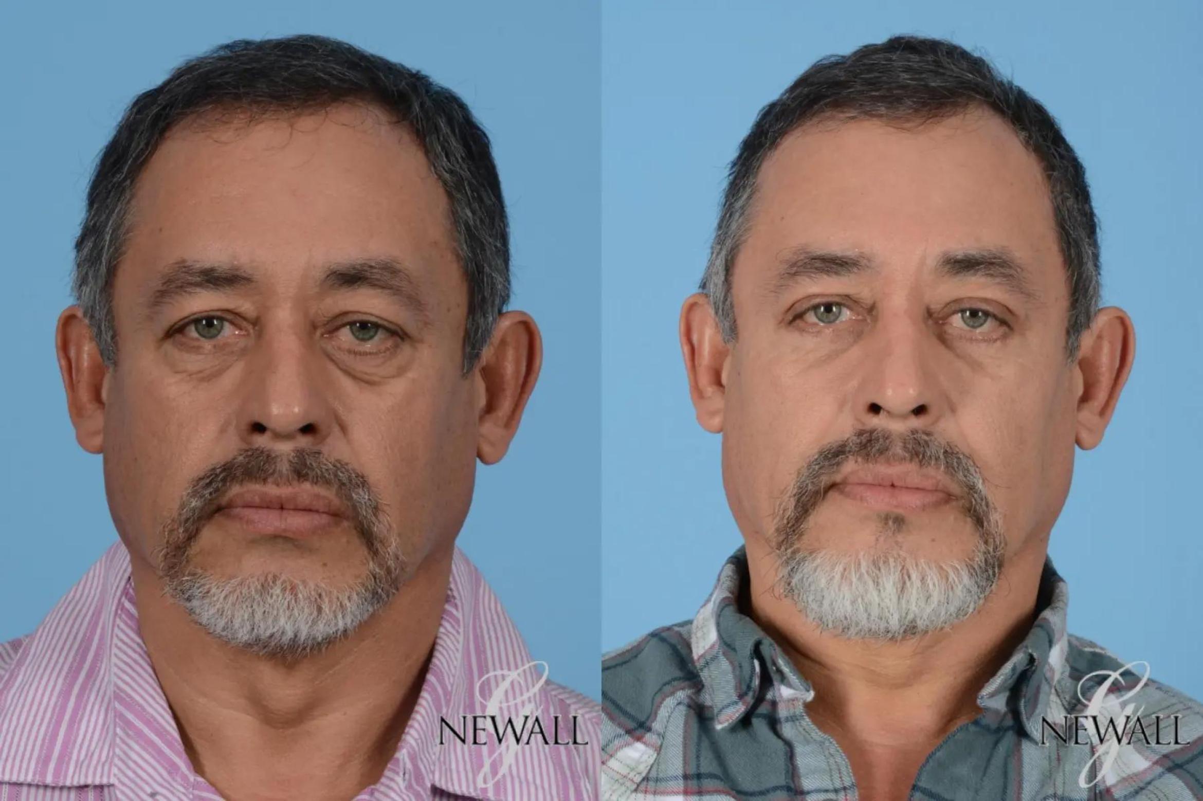 Before & After Facial Fat Grafting For Men Case 17026 View 1 View in Houston, TX