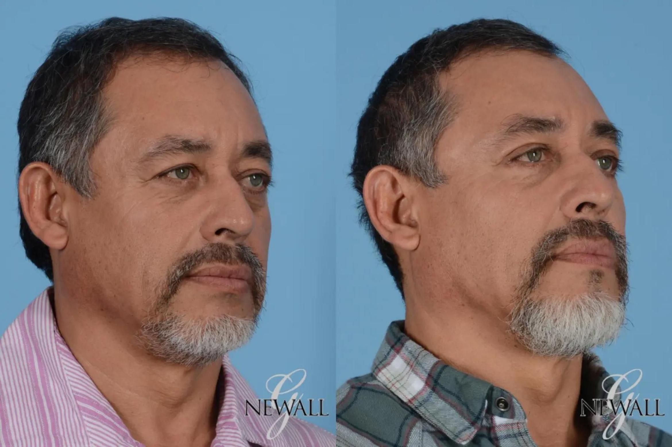 Before & After Facial Fat Grafting For Men Case 17026 View 2 View in Houston, TX
