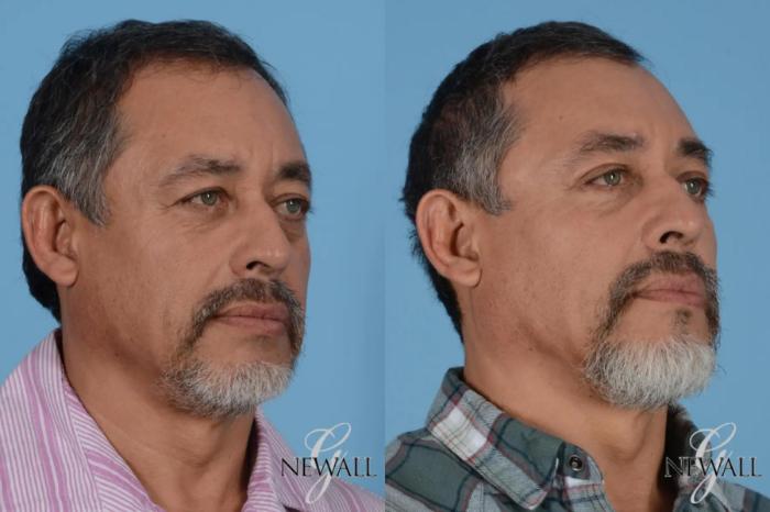 Before & After Facial Fat Grafting For Men Case 17026 View 2 View in Houston, TX