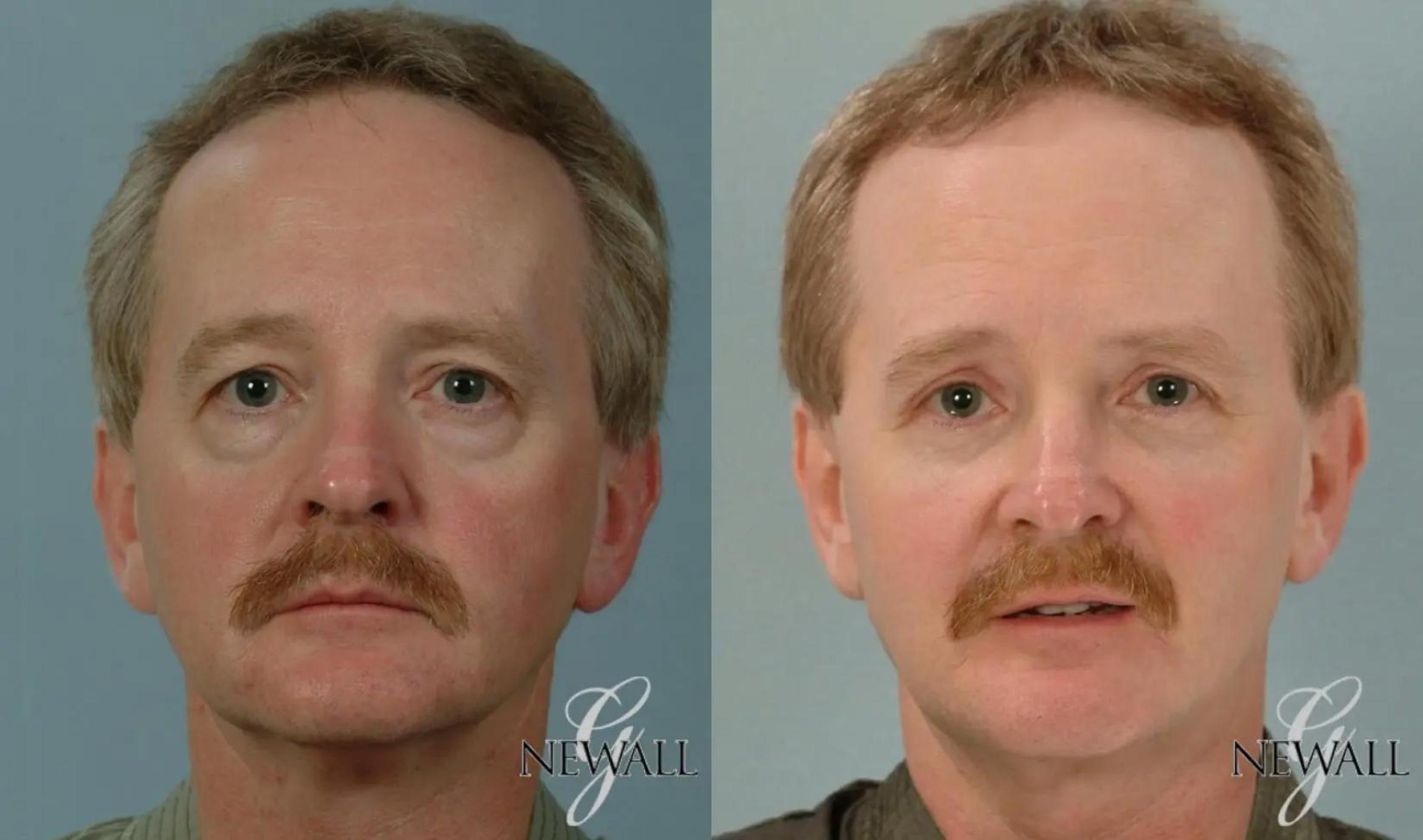 Before & After Facial Fat Grafting For Men Case 17817 View 1 View in Houston, TX