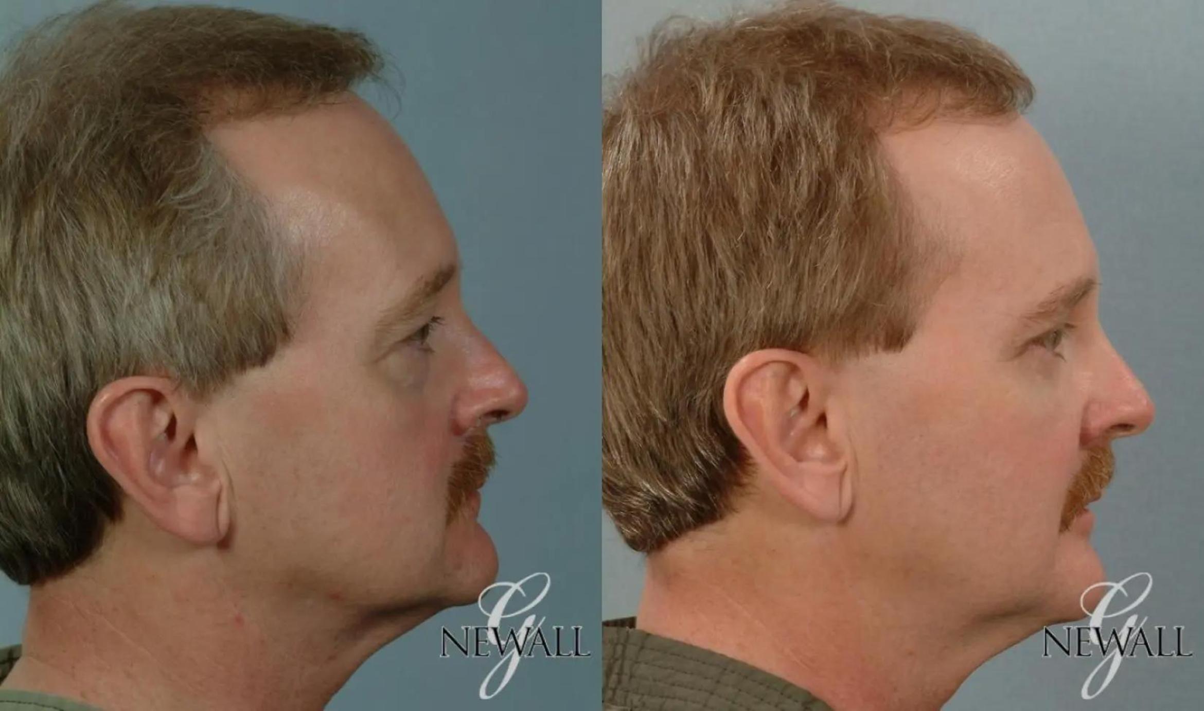Before & After Facial Fat Grafting For Men Case 17817 View 3 View in Houston, TX