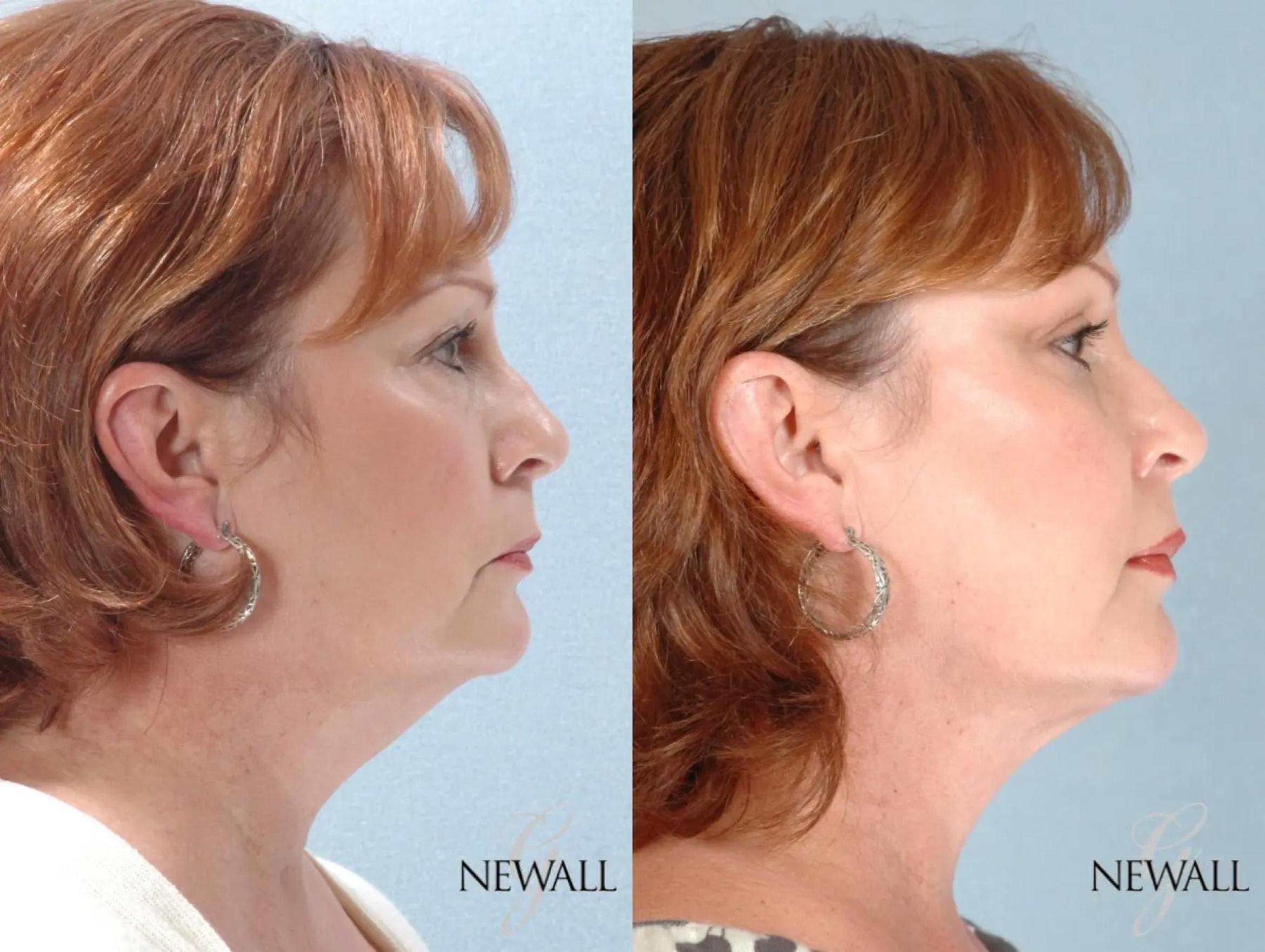 Before & After Fat Transfer - Face Case 17458 View 3 View in Houston, TX