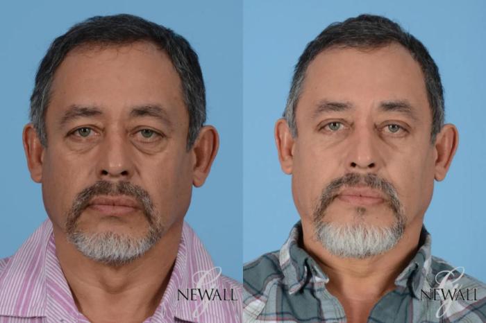 Before & After Fat Transfer - Face For Men Case 17026 View 1 View in Houston, TX