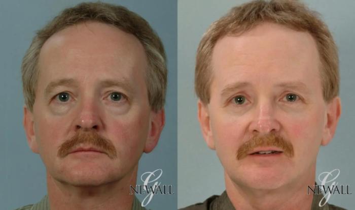 Before & After Fat Transfer - Face For Men Case 17817 View 1 View in Houston, TX