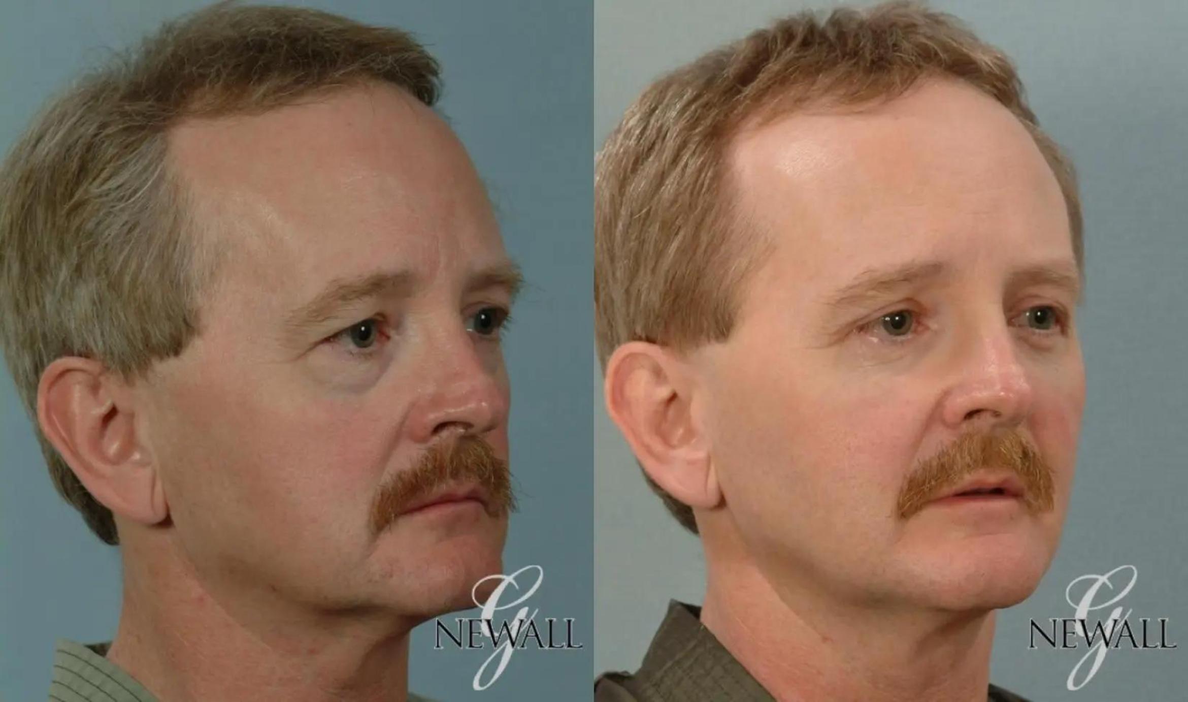 Before & After Fat Transfer - Face For Men Case 17817 View 2 View in Houston, TX