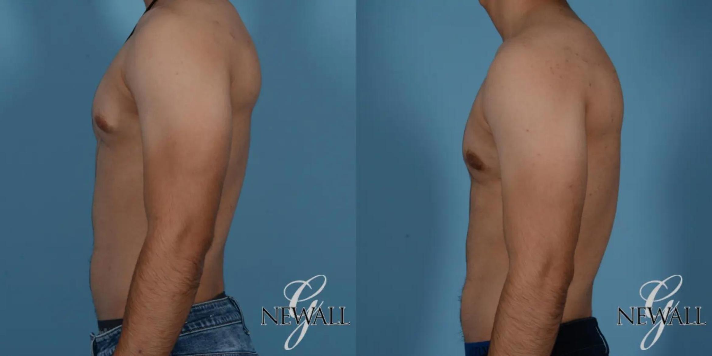 Before & After Gynecomastia Case 17016 View 2 View in Houston, TX