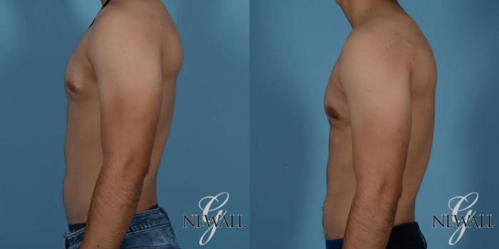 Before & After Gynecomastia Case 17016 View 2 View in Houston, TX