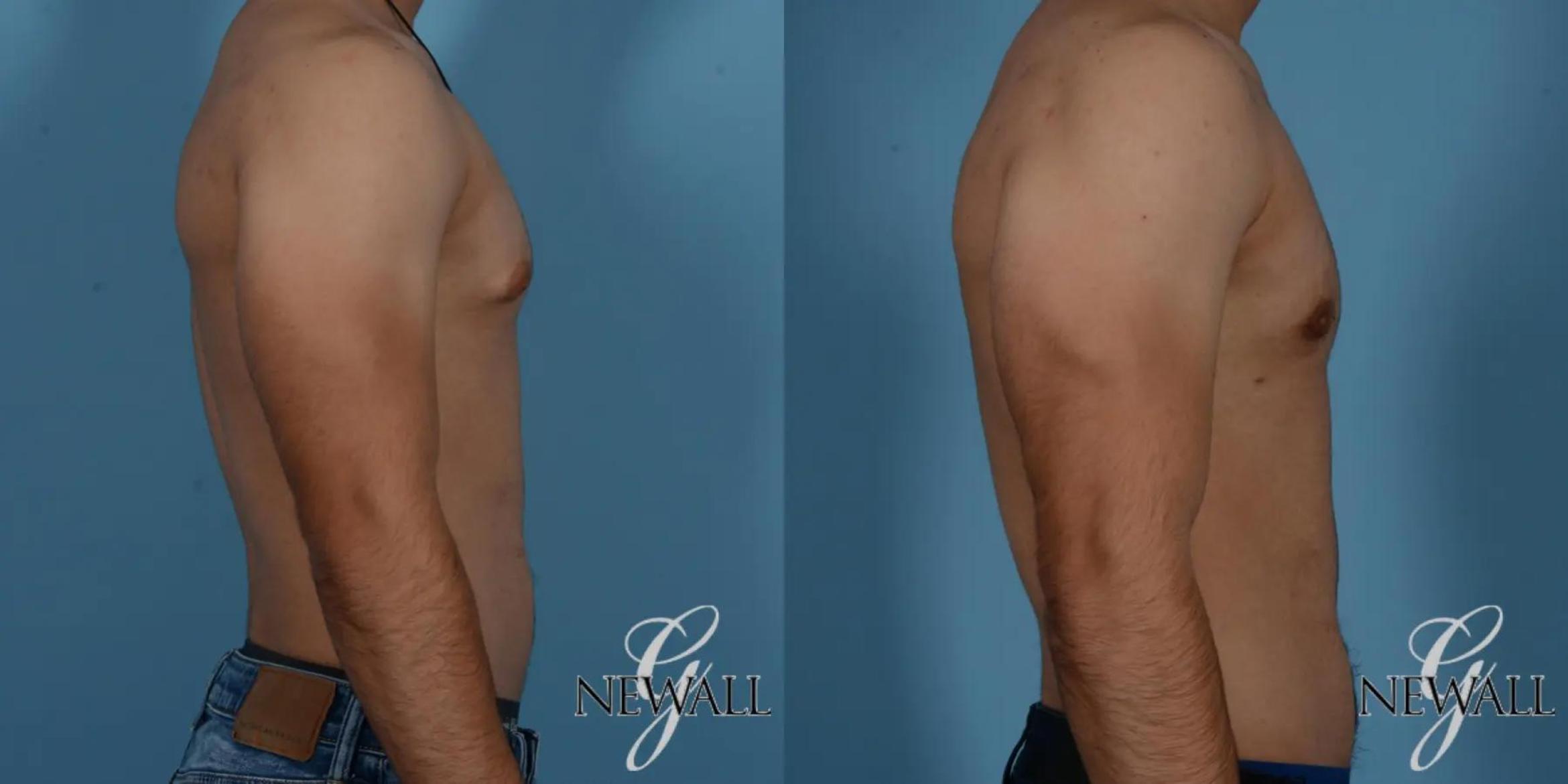 Before & After Gynecomastia Case 17016 View 3 View in Houston, TX