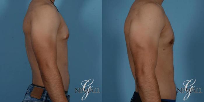 Before & After Gynecomastia Case 17016 View 3 View in Houston, TX