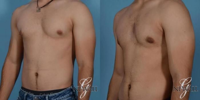 Before & After Gynecomastia Case 17016 View 4 View in Houston, TX