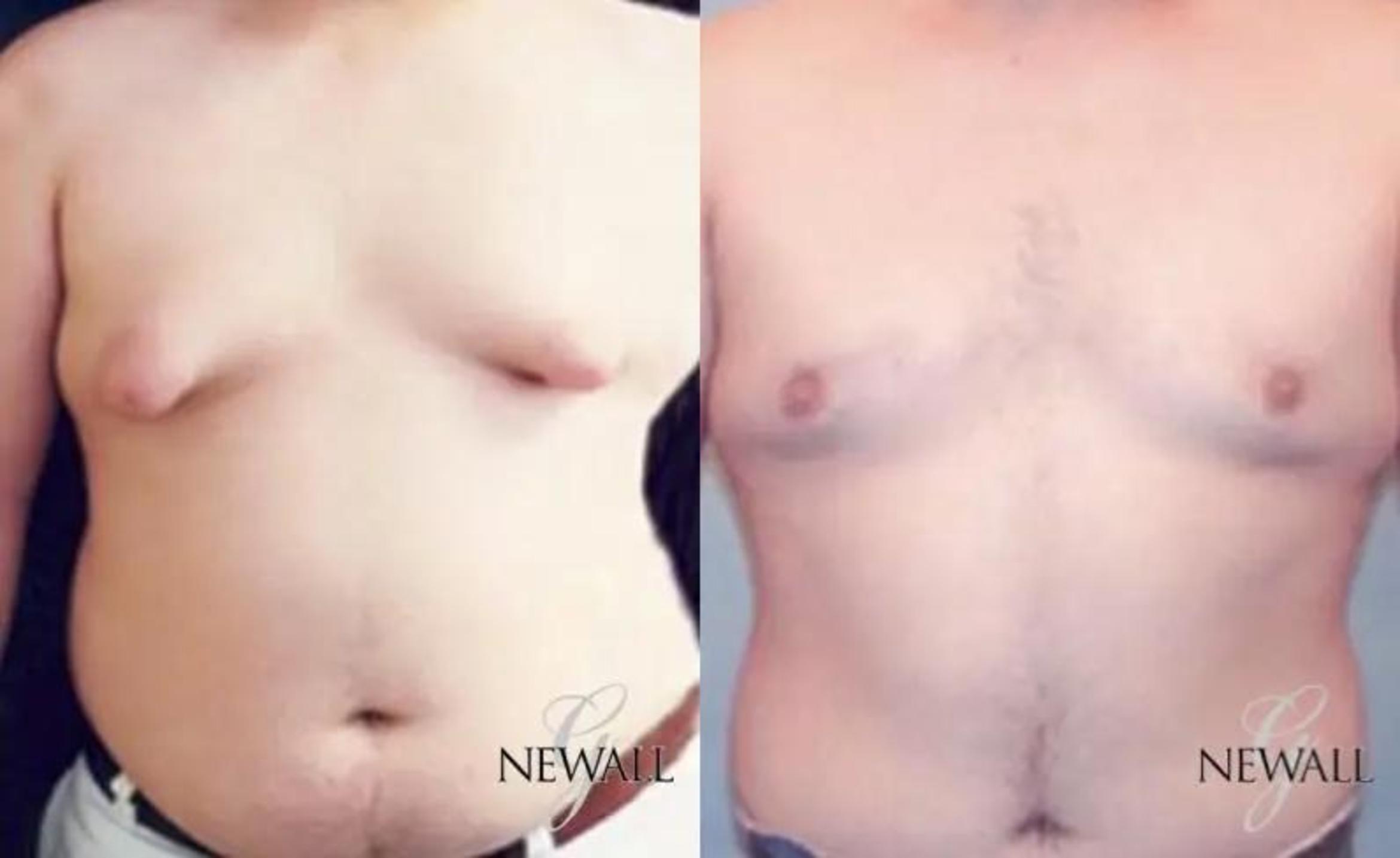 Before & After Gynecomastia Case 17813 View 1 View in Houston, TX