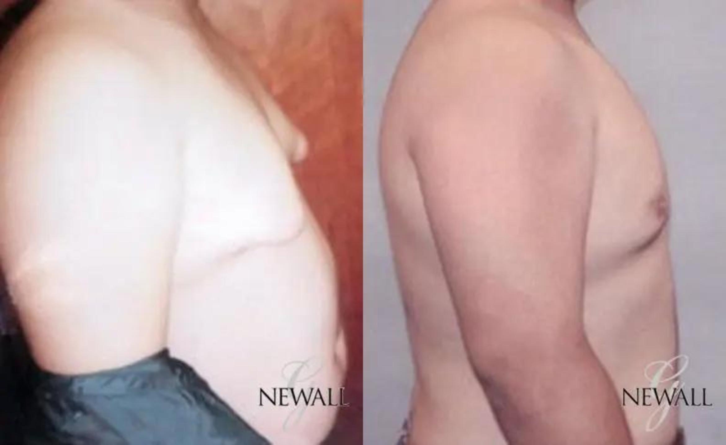 Before & After Gynecomastia Case 17813 View 2 View in Houston, TX