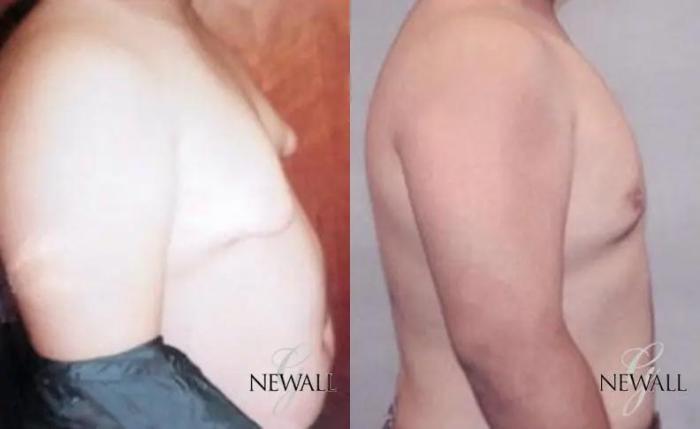 Before & After Gynecomastia Case 17813 View 2 View in Houston, TX