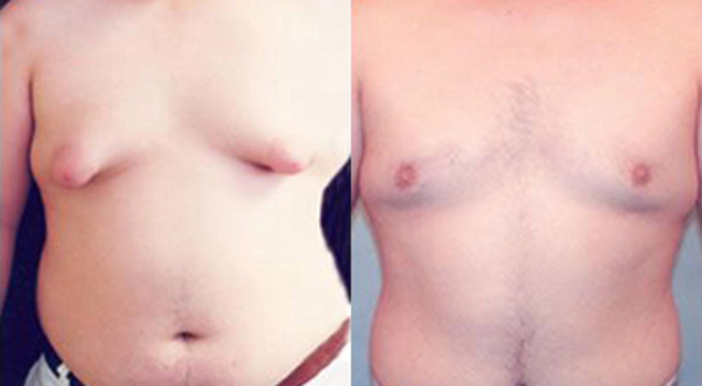 Before & After Gynecomastia Case 5444 View 1 View in Houston, TX