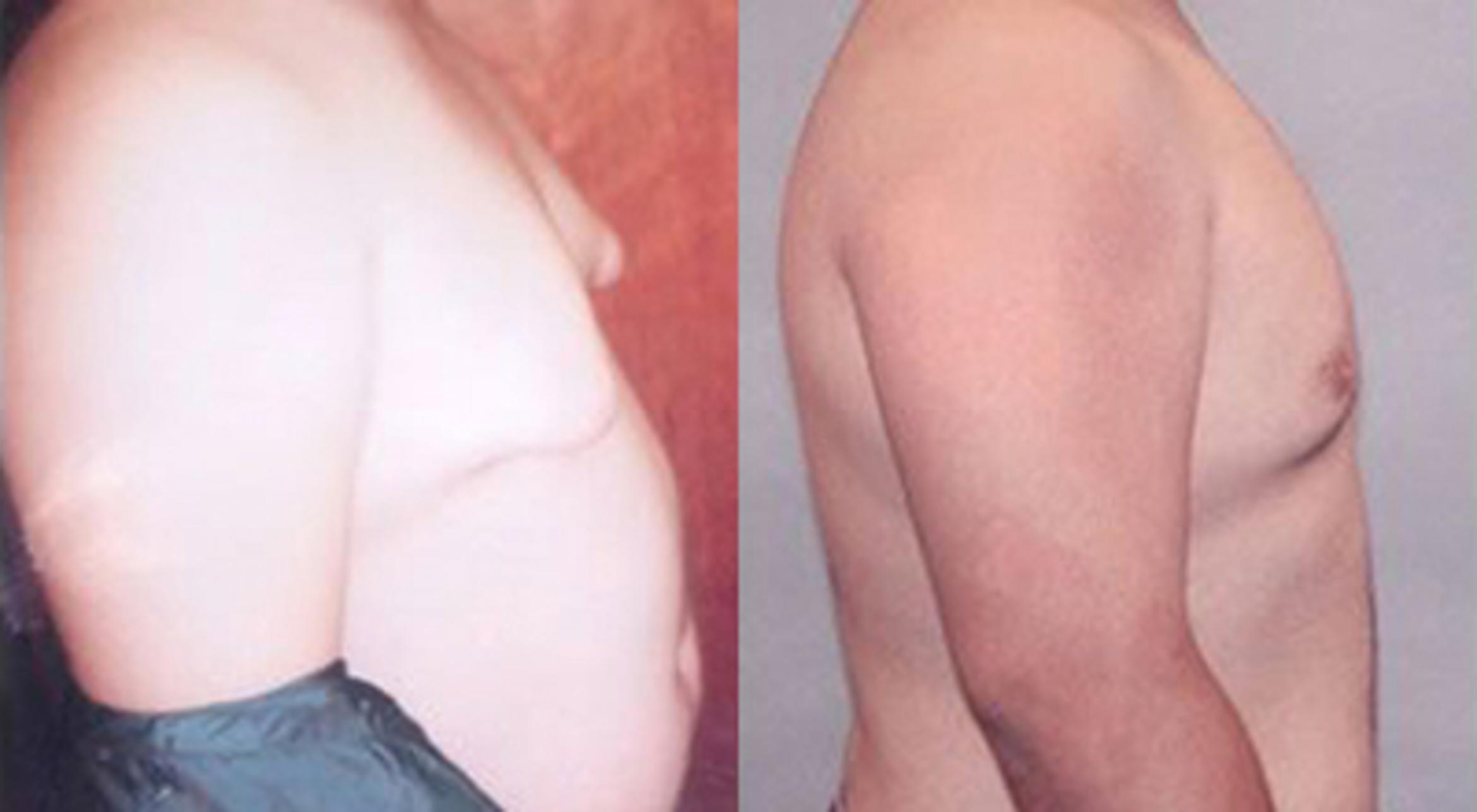 Before & After Gynecomastia Case 5444 View 2 View in Houston, TX