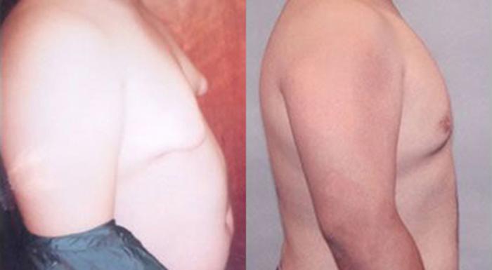 Before & After Gynecomastia Case 5444 View 2 View in Houston, TX