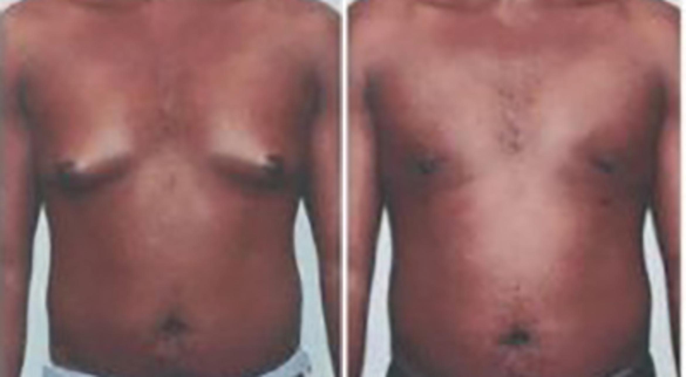 Before & After Gynecomastia Case 5450 View 1 View in Houston, TX