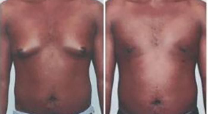Before & After Gynecomastia Case 5450 View 1 View in Houston, TX