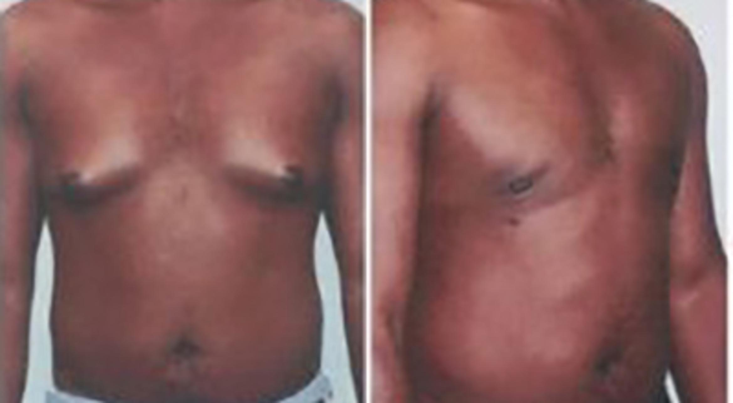 Before & After Gynecomastia Case 5450 View 2 View in Houston, TX