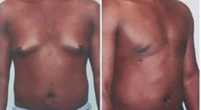 Before & After Gynecomastia Case 5450 View 2 View in Houston, TX