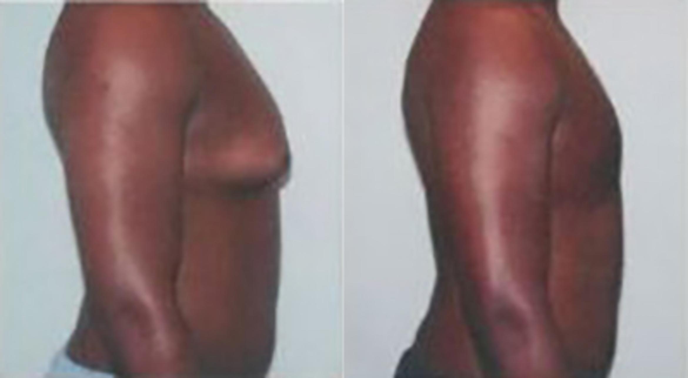 Before & After Gynecomastia Case 5450 View 3 View in Houston, TX