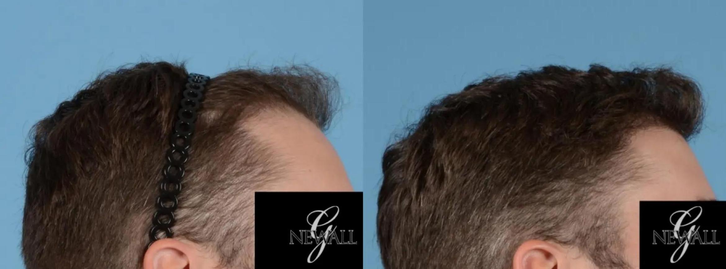 Before & After Hair Transplantation For Men Case 16975 View 2 View in Houston, TX