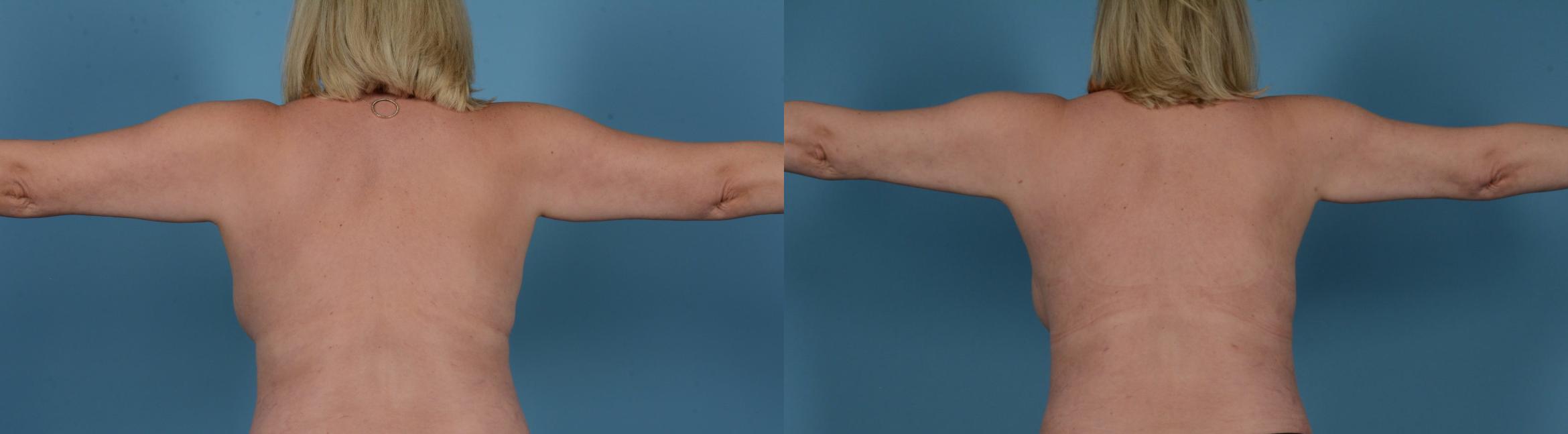 Before & After Liposuction Case 119183820 View 1 View in Houston, TX
