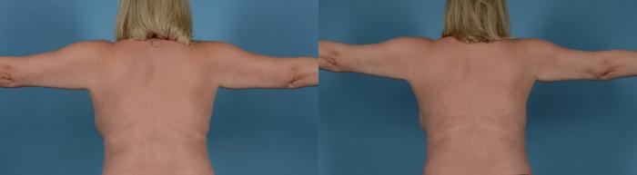 Before & After Liposuction Case 119183820 View 1 View in Houston, TX
