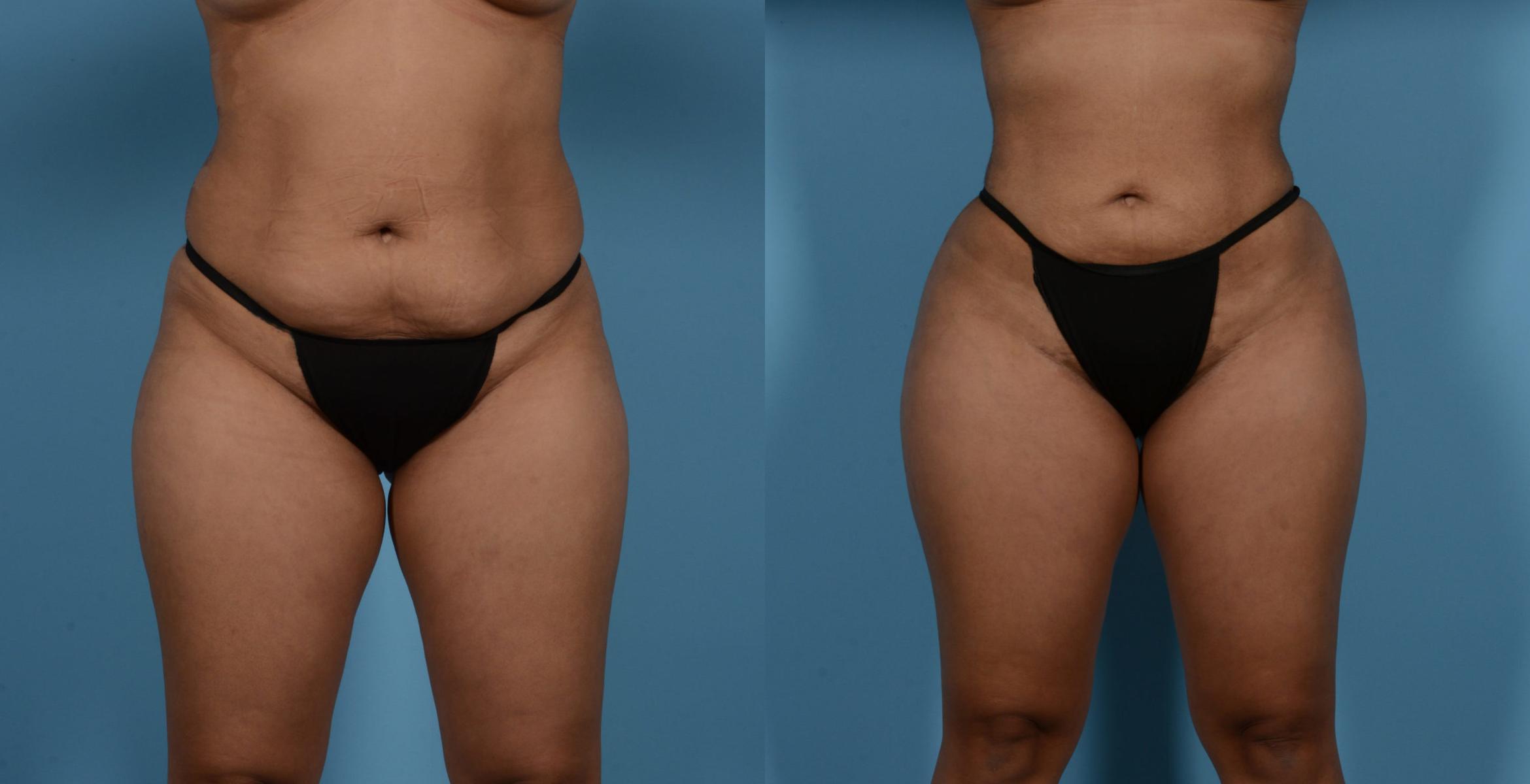 Before & After Liposuction Case 138066 View 1 View in Houston, TX
