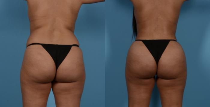 Before & After Liposuction Case 138066 View 2 View in Houston, TX
