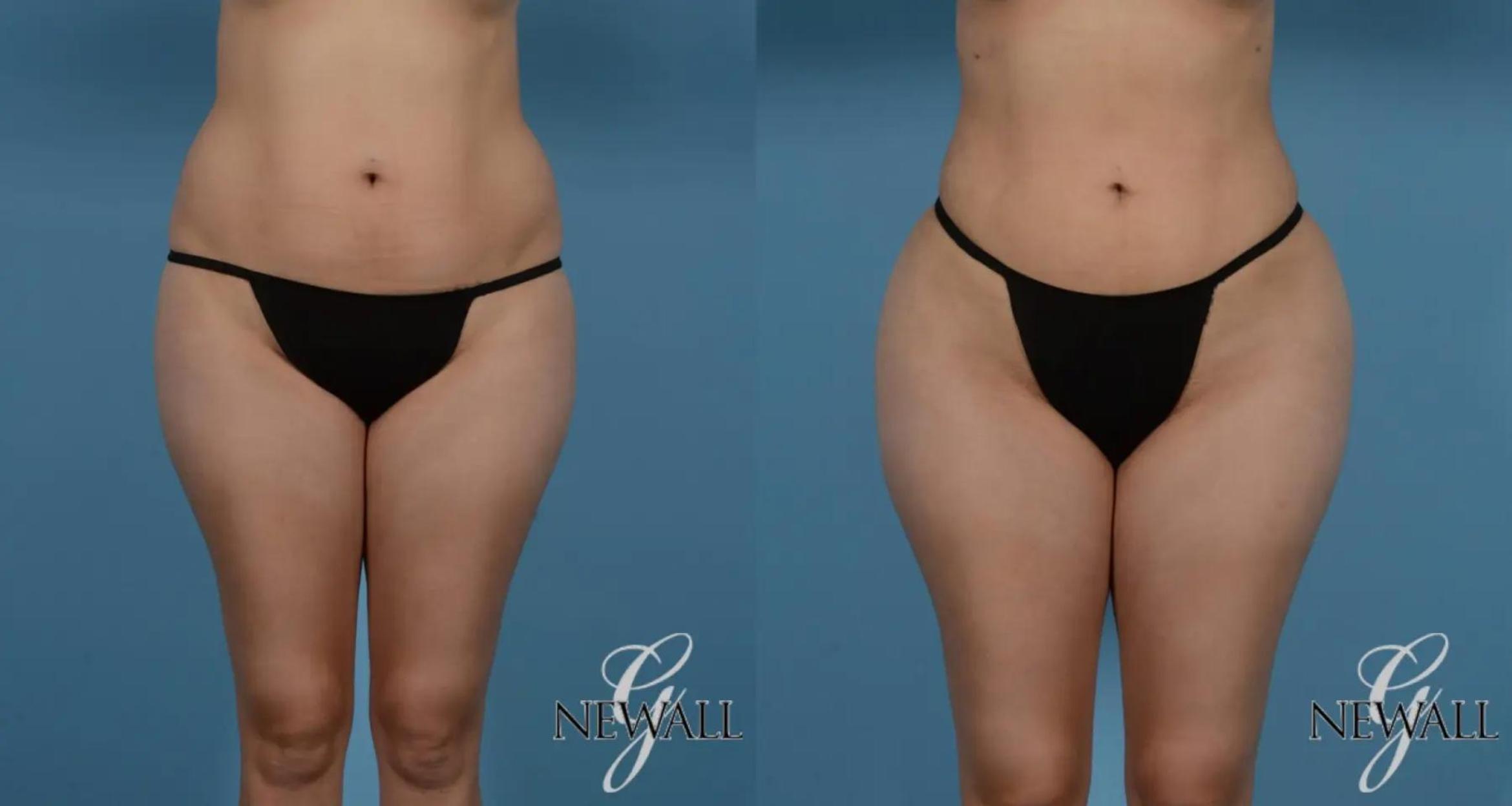 Before & After Liposuction Case 16979 View 1 View in Houston, TX