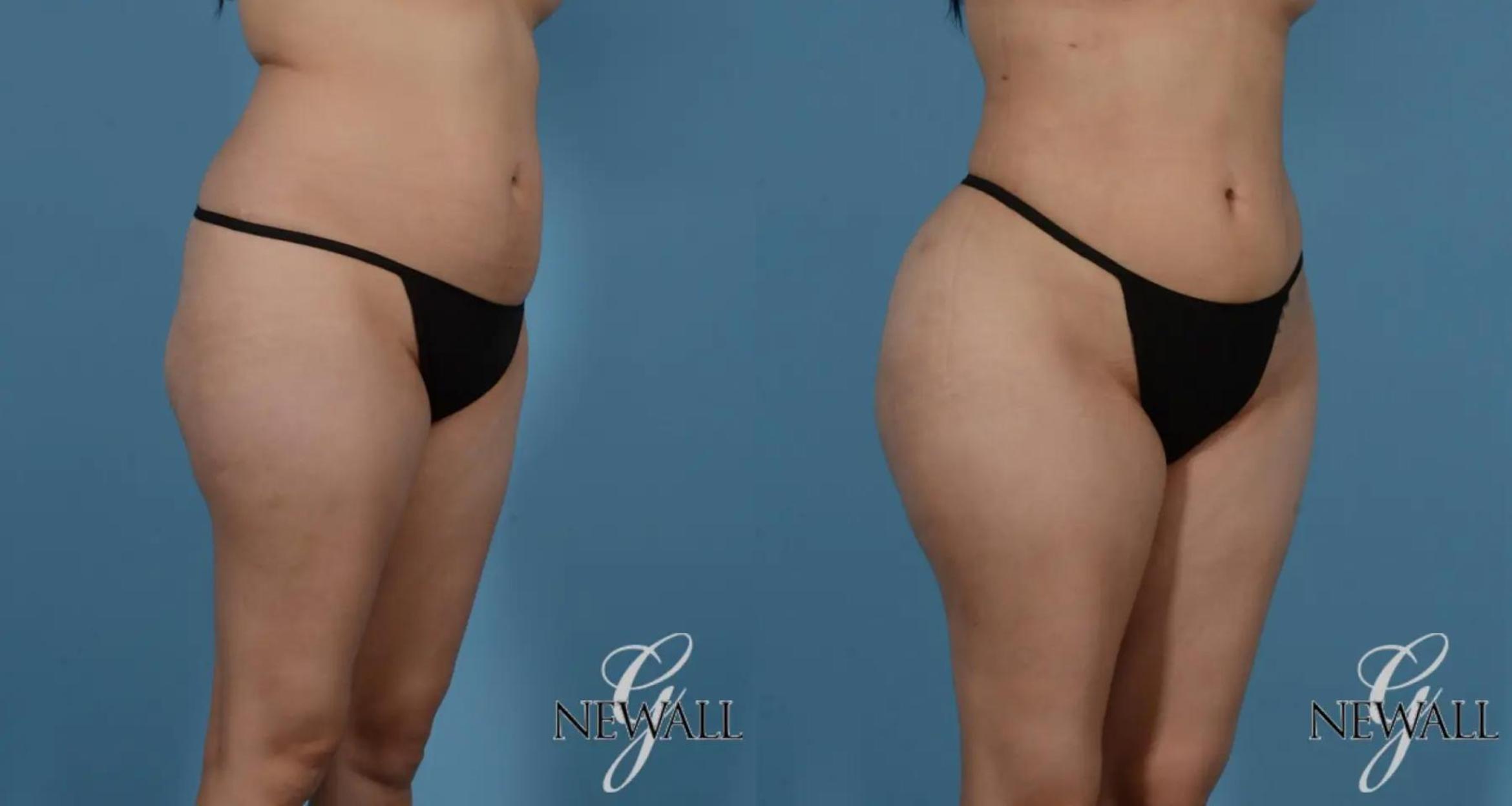 Before & After Liposuction Case 16979 View 2 View in Houston, TX