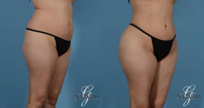Before & After Liposuction Case 16979 View 2 View in Houston, TX