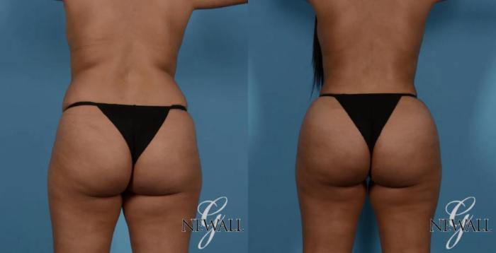 Before & After Liposuction Case 16983 View 2 View in Houston, TX