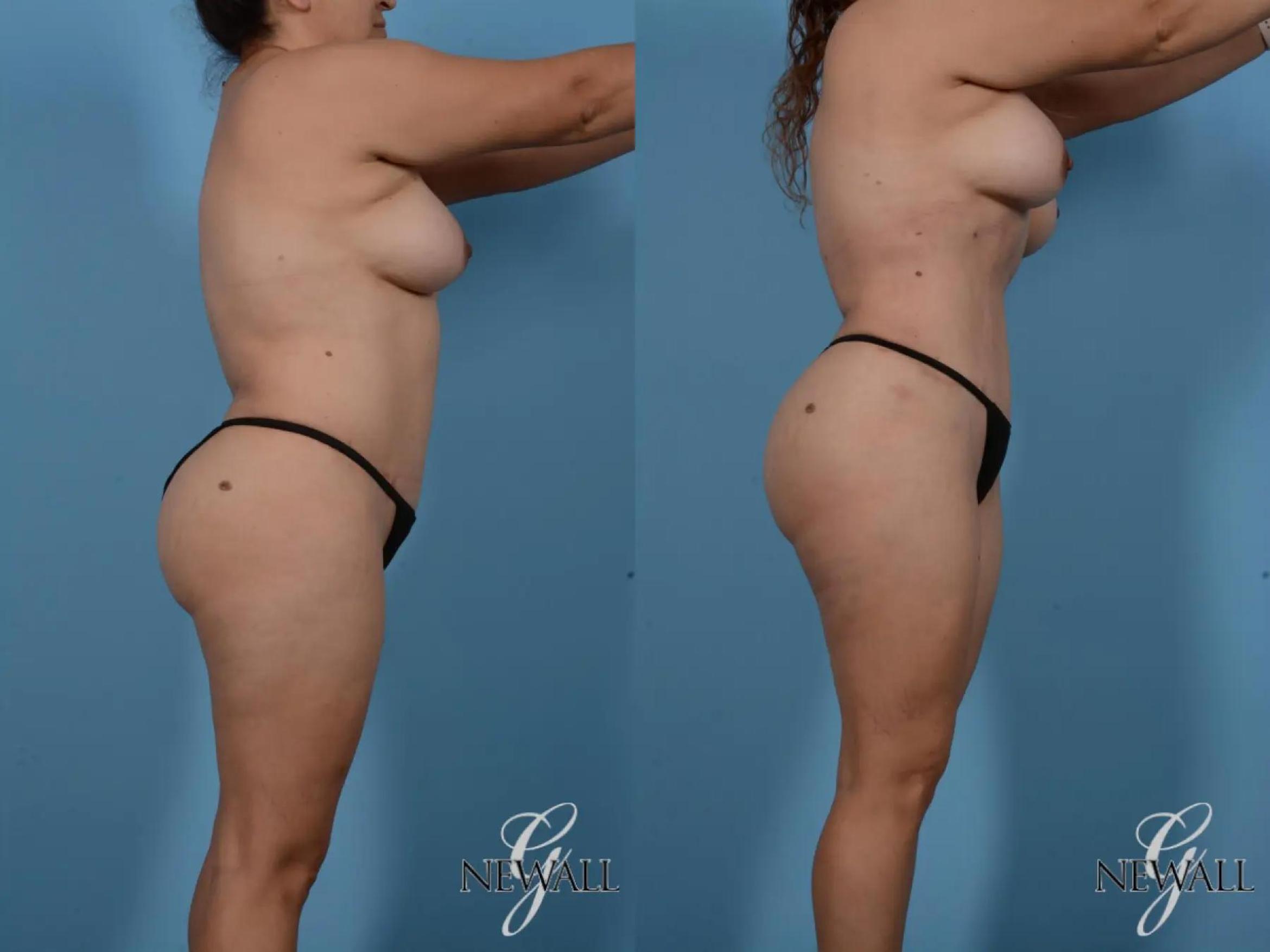 Before & After Liposuction Case 16993 View 2 View in Houston, TX