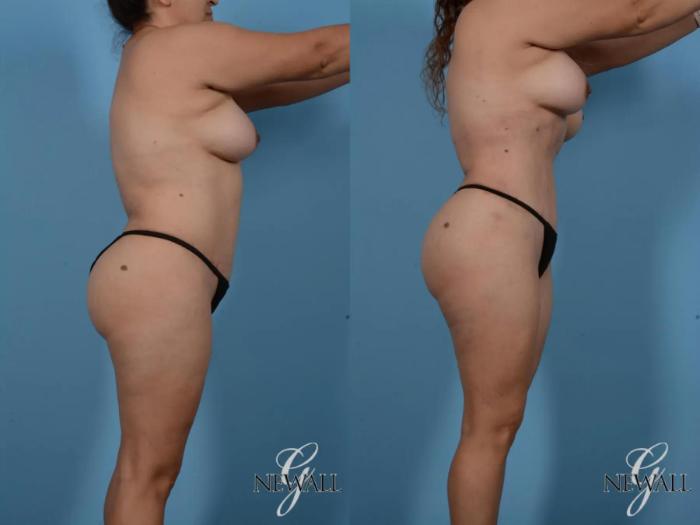 Before & After Liposuction Case 16993 View 2 View in Houston, TX