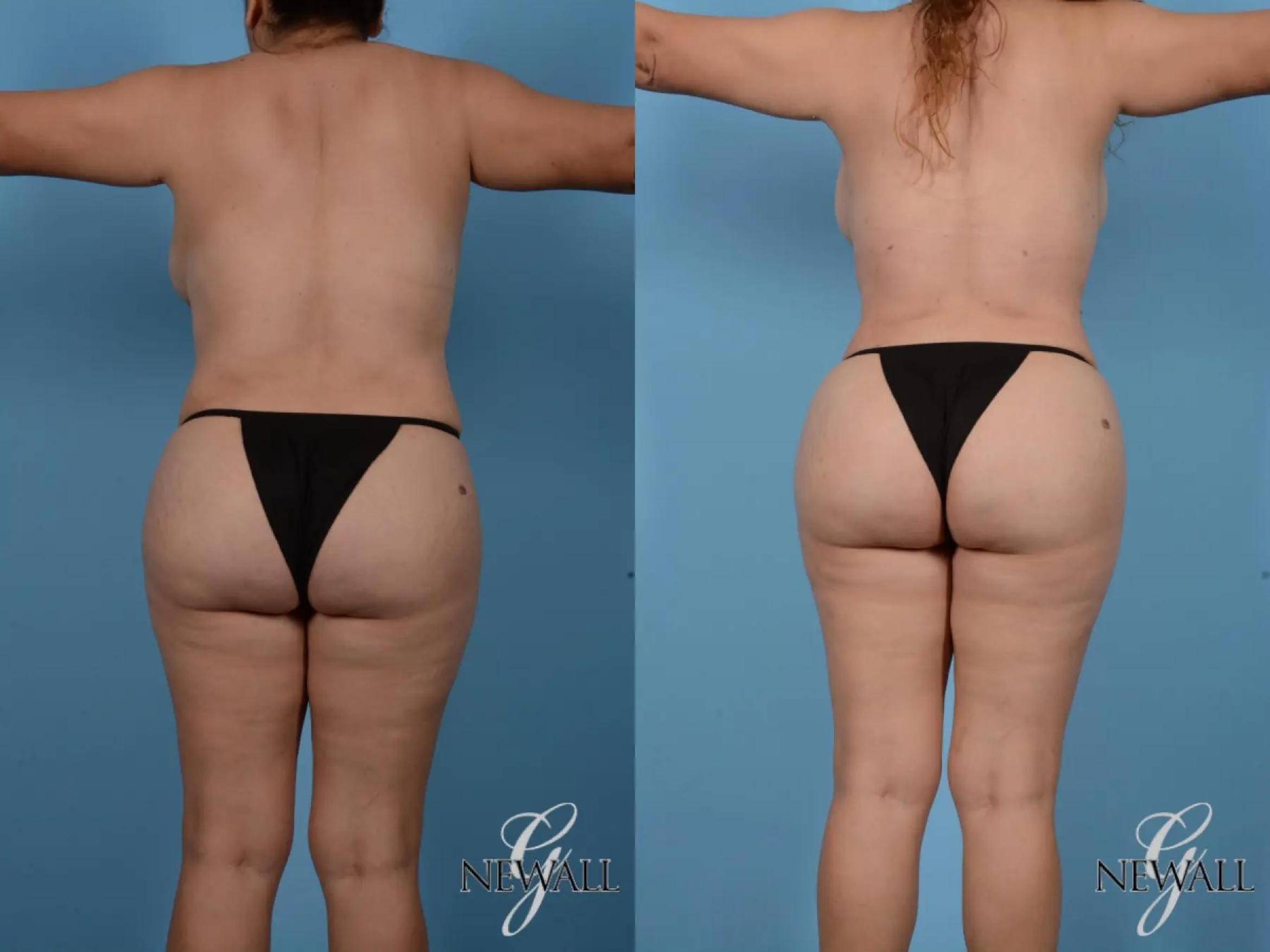Before & After Liposuction Case 16993 View 3 View in Houston, TX