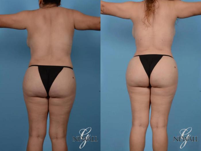 Before & After Liposuction Case 16993 View 3 View in Houston, TX