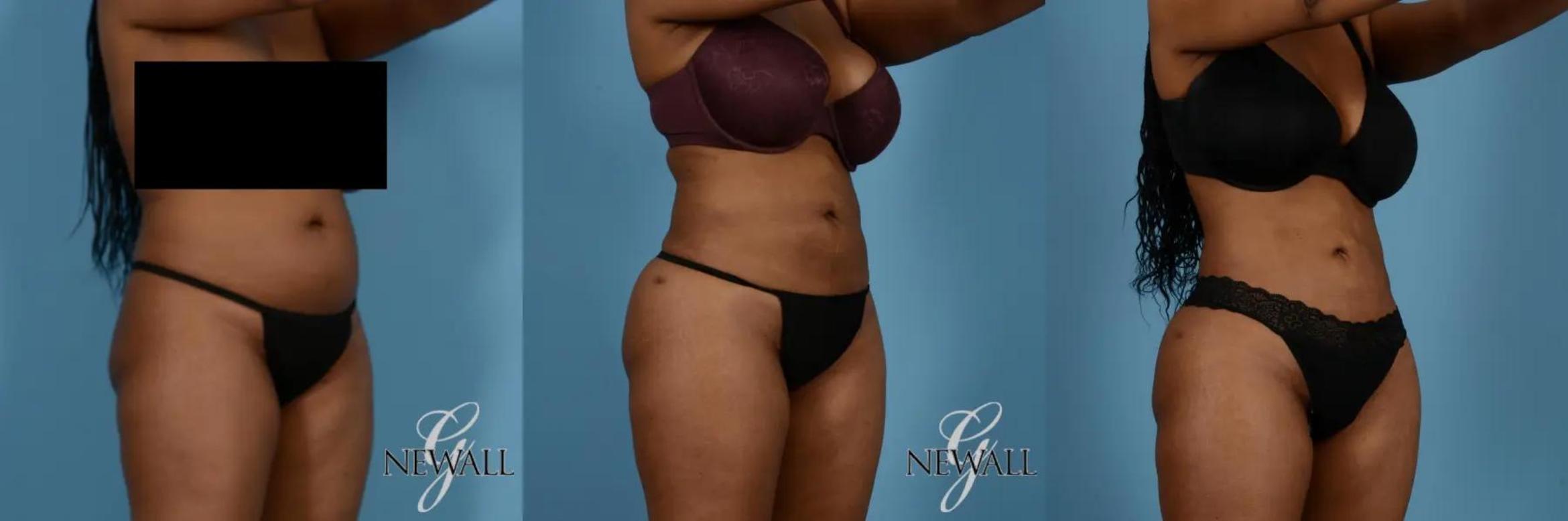 Before & After Liposuction Case 17019 View 2 View in Houston, TX