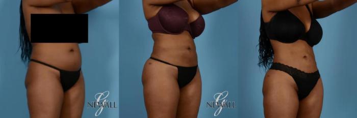 Before & After Liposuction Case 17019 View 2 View in Houston, TX