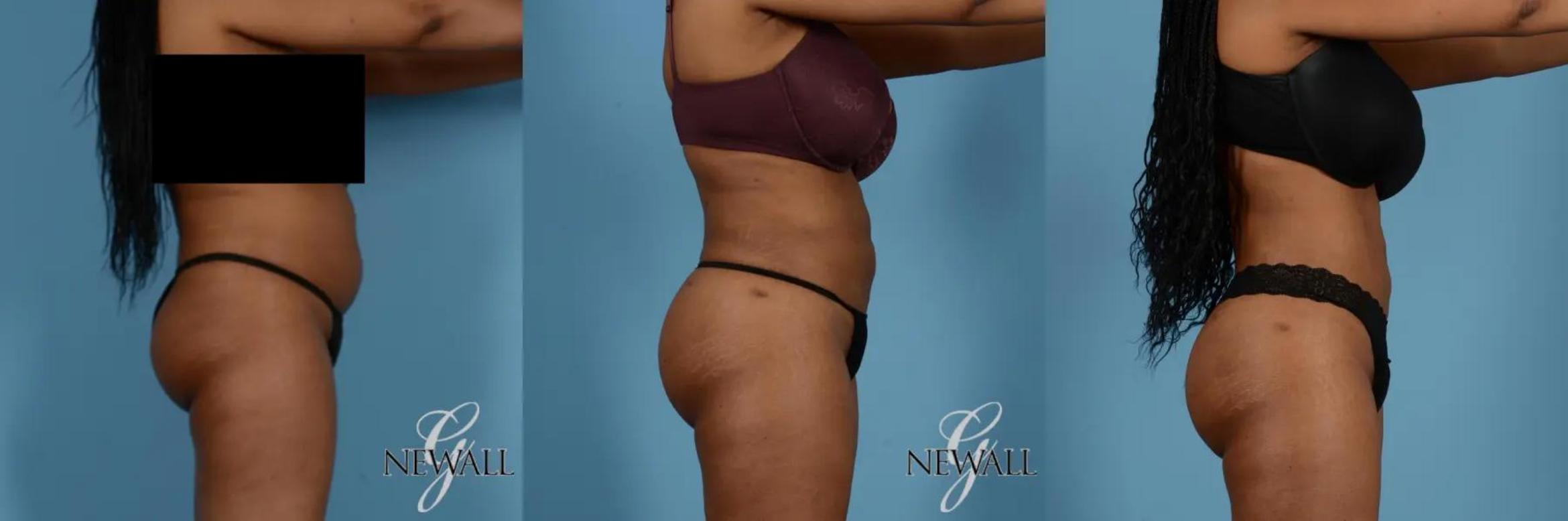 Before & After Liposuction Case 17019 View 3 View in Houston, TX