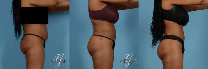 Before & After Liposuction Case 17019 View 3 View in Houston, TX