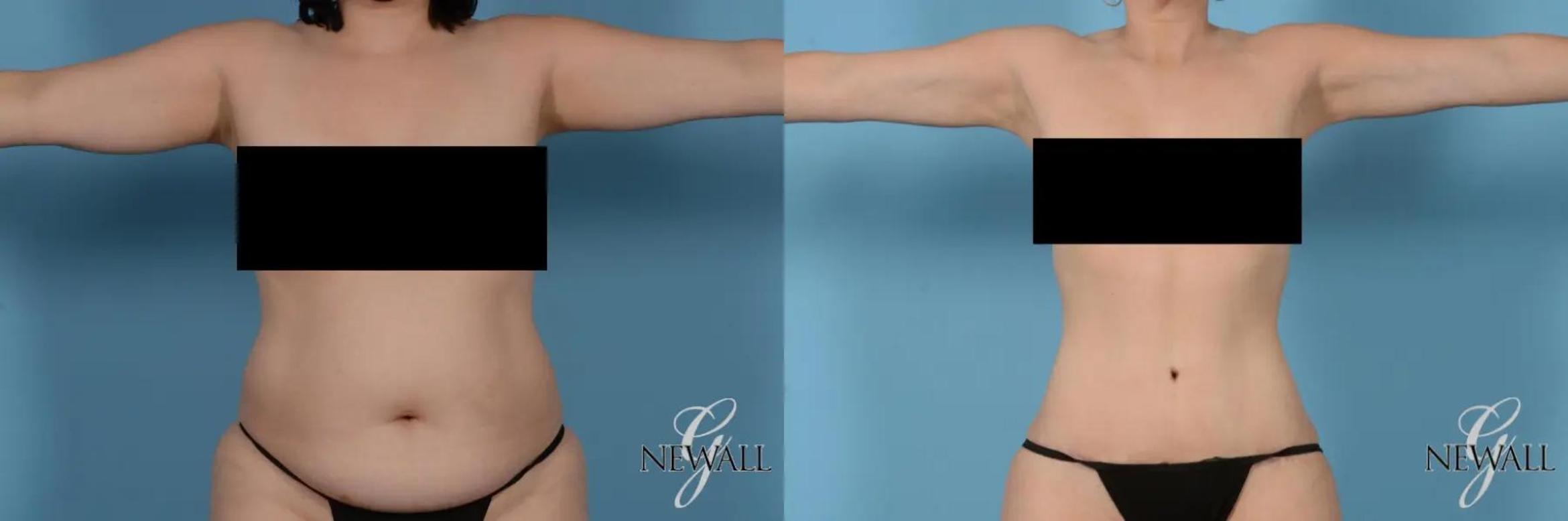 Before & After Liposuction Case 17442 View 1 View in Houston, TX